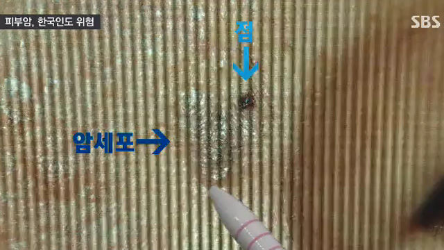 [취재파일] 피부암