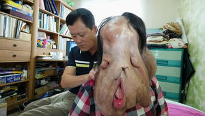 얼굴 덮은 거대한 혹&hellip;"응원합니다" 치료 시작