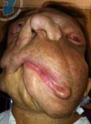 신경섬유종 앓던 폴란드 여인 조애너