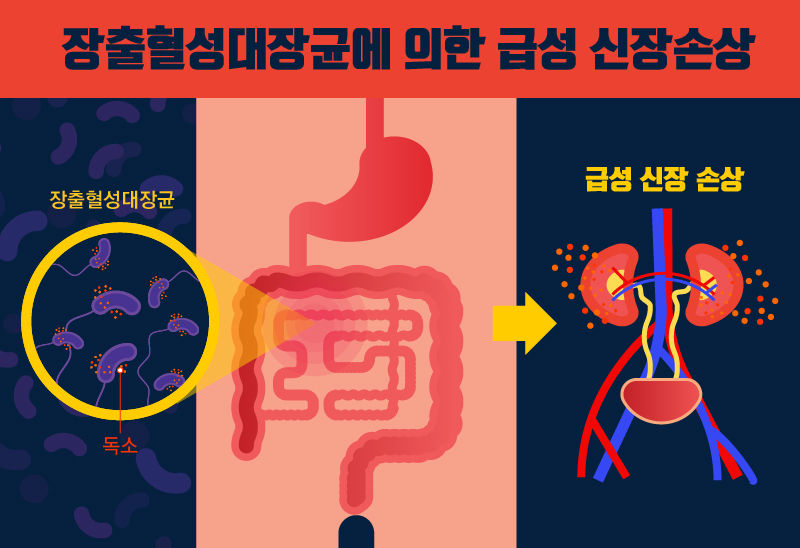 장출혈성대장균에 의한 급성 신장 손상