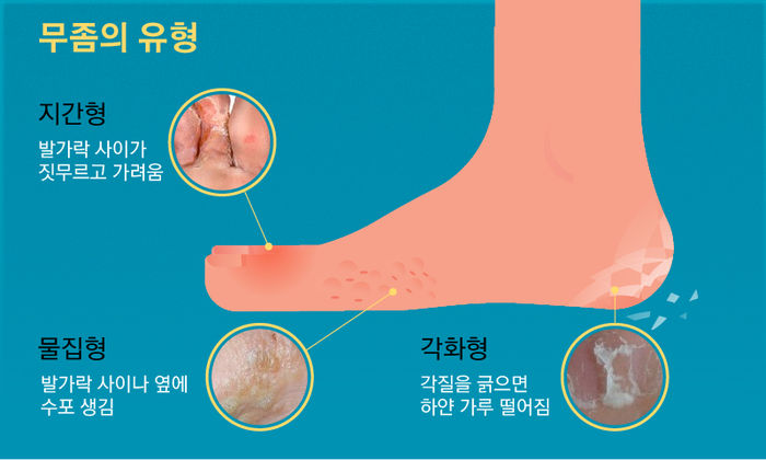 여름철 필수 아이템 '쪼리'…발가락 기형 만드는 주범?