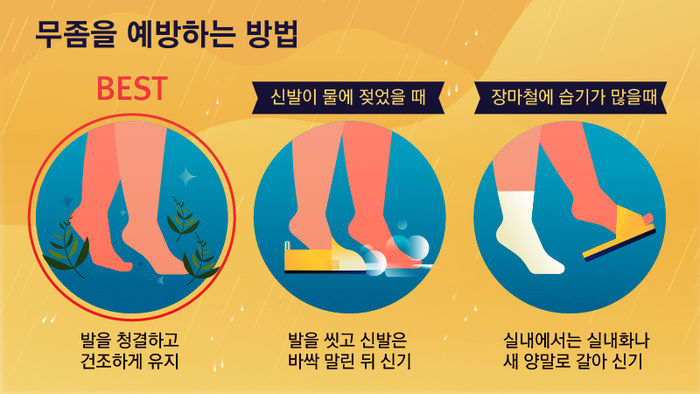 여름철 필수 아이템 '쪼리'…발가락 기형 만드는 주범?
