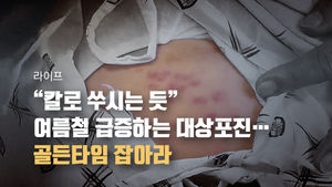 [라이프] "칼로 쑤시는 듯" 여름철 급증하는 대상포진…골든타임 잡아라