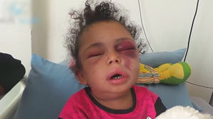 극적 구조된 6살 소녀&hellip;'퉁퉁 부은 눈'에 담긴 예멘 참상