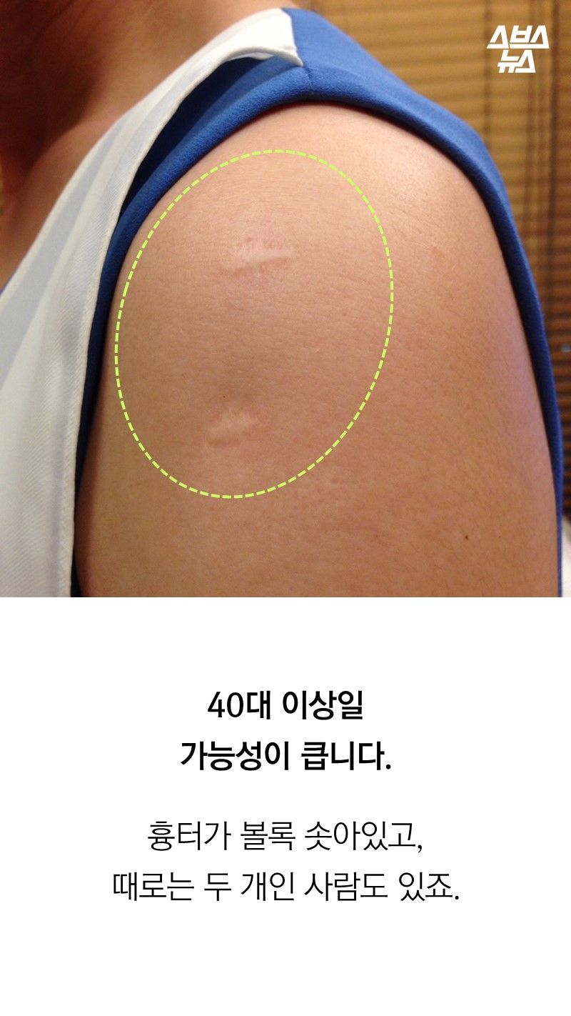 40대 이상일
가능성이 큽니다.
흉터가 볼록 솟아있고,
때로는 두 개인 사람도 있죠.