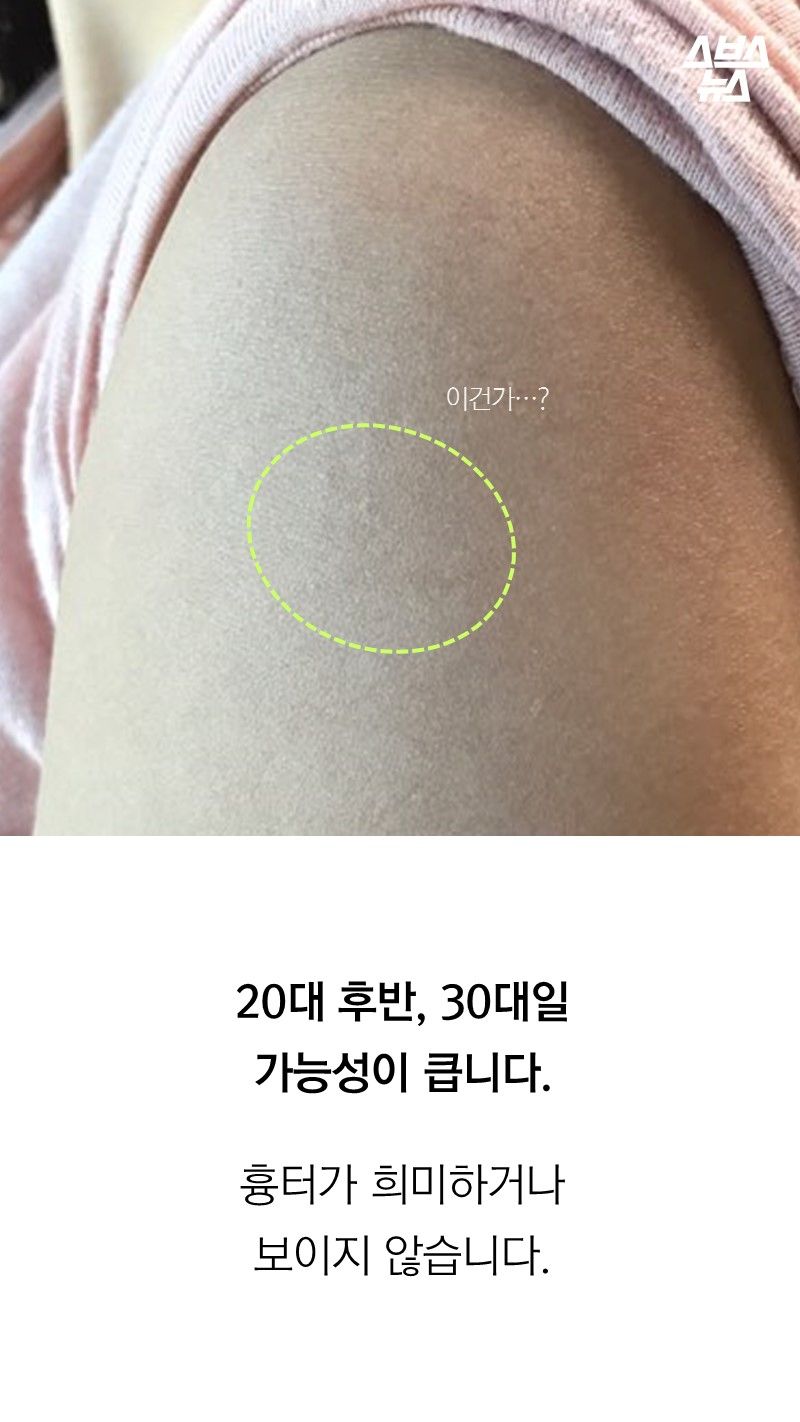 20대 후반, 30대일
가능성이 큽니다.
흉터가 희미하거나
보이지 않습니다.