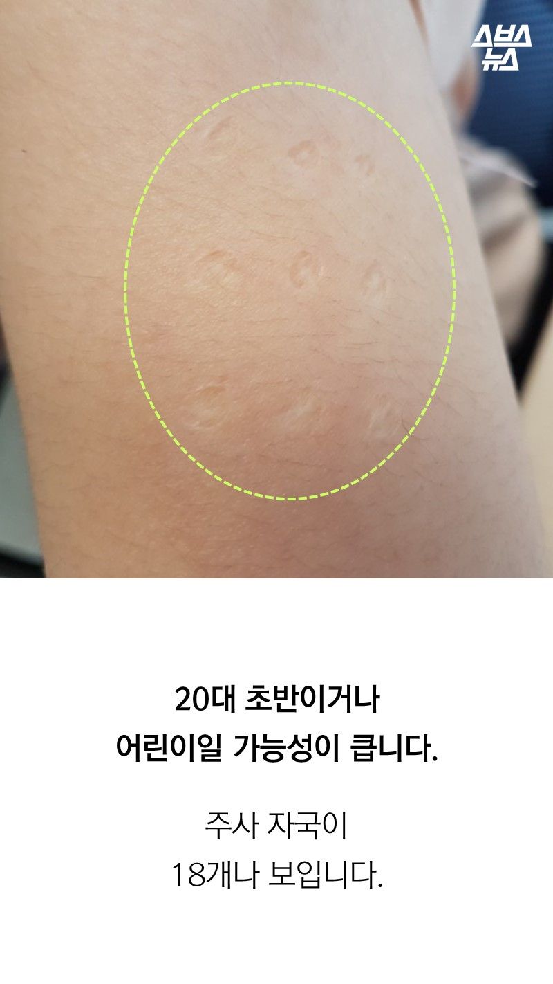 20대 초반이거나
어린이일 가능성이 큽니다.
주사 자국이
18개나 보입니다.