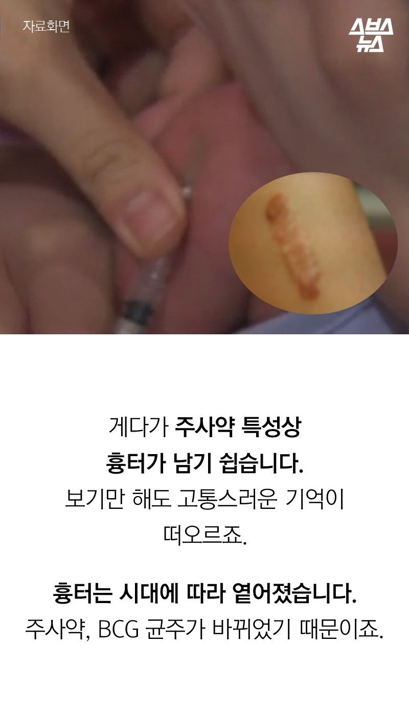 게다가 주사약 특성상
흉터가 남기 쉽습니다.
보기만 해도 고통스러운 기억이
떠오르죠.
흉터는 시대에 따라 옅어졌습니다.
주사약, BCG 균주가 바뀌었기 때문이죠.