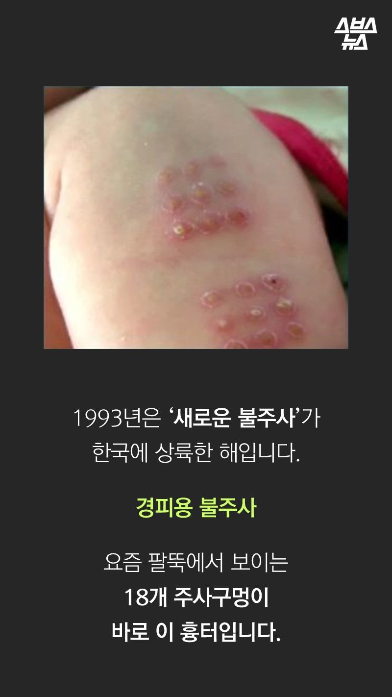 1993년은 ‘새로운 불주사’가
한국에 상륙한 해입니다.
경피용 불주사
요즘 팔뚝에서 보이는
18개 주사구멍이
바로 이 흉터입니다.