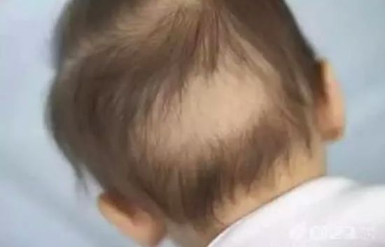 과도한 수업으로 '원형탈모' 걸린 3살 아이