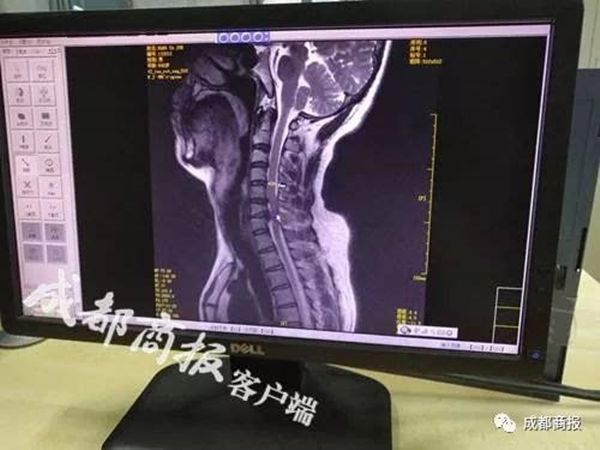 매일 엎드려 2시간씩 휴대폰 사용한 남성…마비 증상으로 배변도 못 가려