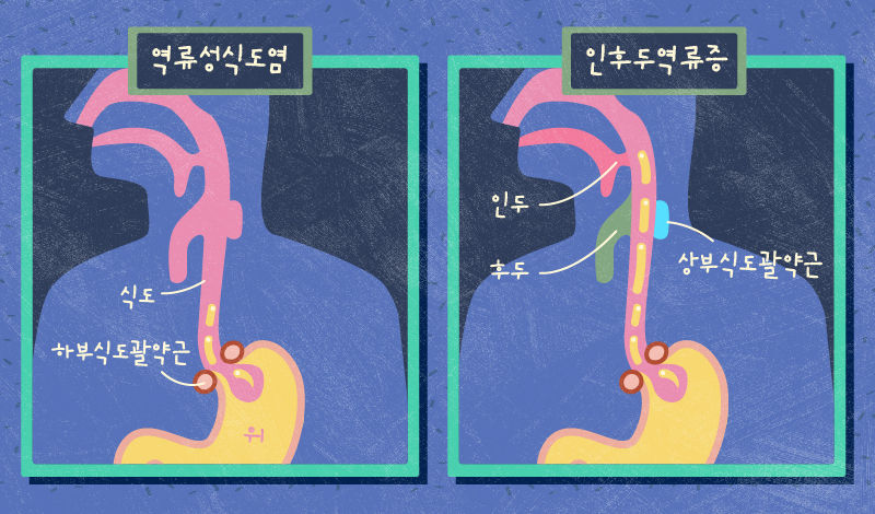 *그래픽
역류성식도염&인후두역류증 //