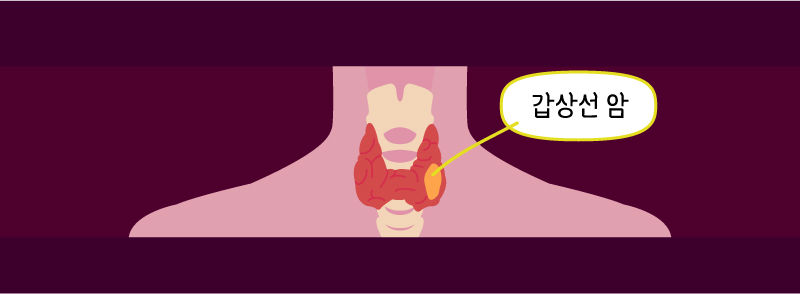 [(4일용) 라이프] '갑상선암이 착한 암이라고요?