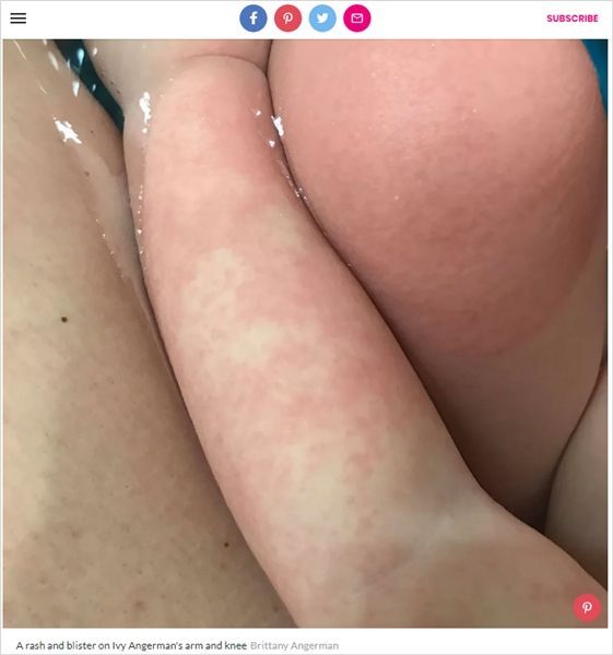 '물 알레르기' 걸린 꼬마의 사연