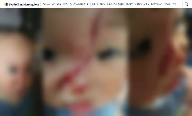 드론이 얼굴 강타해 7바늘 꿰맨 아이…드론의 위험성
