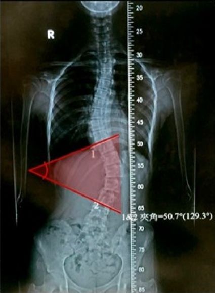 매일 옆으로 누워서 스마트폰 하던 10대…척추 50도 휘어