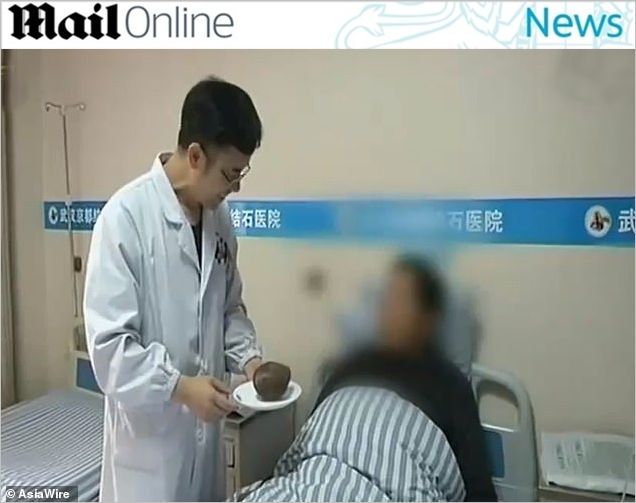 소변 참던 남성 방광에서 발견된 놀라운 정체