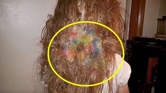 장난감에 머리카락 엉켜 민머리 될 뻔한 5살 아이