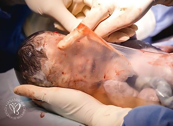 '양막'에 싸여 태어난 아기