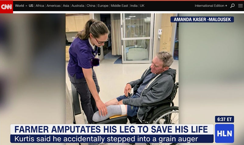 농기계에 낀 다리 스스로 절단해 목숨 건진 남성(사진=CNN 홈페이지 캡처)
