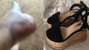 샌들 신다 잡힌 물집 때문에 '패혈증' 와서 다리 잃을 뻔 여성 (사진=메트로 홈페이지 캡처)