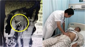 '악습관'이 가져온 시련&hellip;한 남성이 위벽에 구멍 나 수술받은 이유
