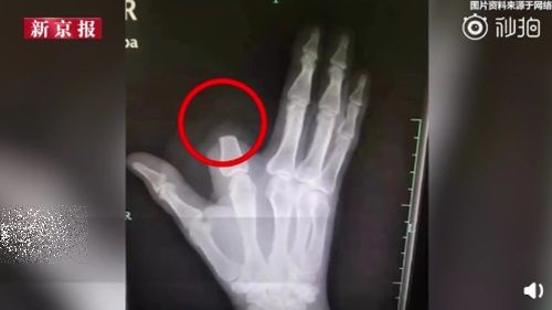 땔감 베다 봉변…뱀에 손가락 물린 농부의 너무 성급한(?) 대처