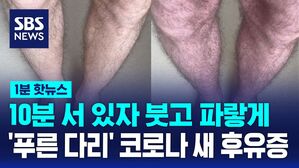 [1분핫뉴스] 10분 서 있자 다리가 푸른색으로&hellip;코로나 새 후유증 '푸른 다리 증상' 발견