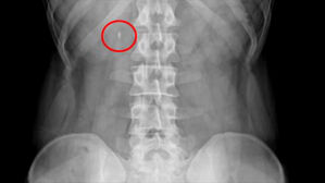옆구리 찌릿! 혹시 요로결석?&hellip;AI가 CT 영상 분석해 찾아낸다