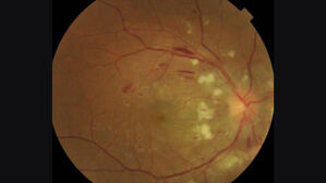 고혈압, 눈에도 치명타&hellip;"자각 증상 없이 망막 망가뜨려"