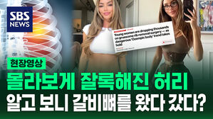 [현장영상] "갈비뼈 제거하거나 위치 조정" 미국에서 유행하는 시술 뭐길래