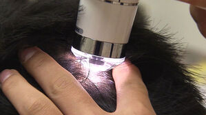 [이슈빡] '탈모 건보 적용' 검토&hellip;지금 우선순위는 무엇?