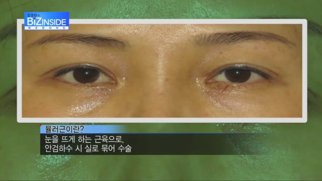  눈이 안 감겨요 …쌍꺼풀 재수술로 다시 예뻐지자