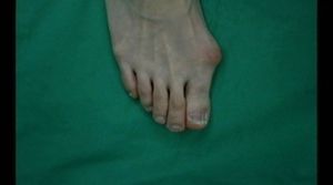 하이힐로 인한 무지외반증 환자 5년새 77%↑