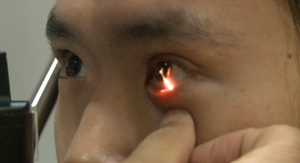 [건강] 그냥 눈 나빠진 줄 알고&hellip;24살에 백내장?
