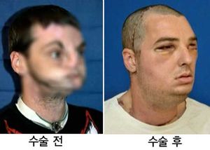 15년 코&middot;입 없던 사나이, 감쪽같은 새 얼굴