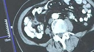 최근 5년간 폐암환자 지속 증가&hellip;'흡연'이 주범