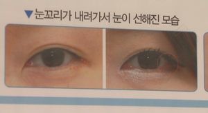 의료광고 '사전 심의' 도입&hellip;부작용 설명해야