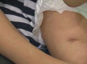 예방주사 맞은 영아 집단 '종창'&hellip;의료사고 논란