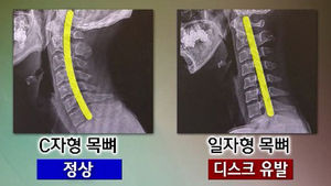 [건강리포트] 목디스크 환자, 5년 사이 54% 급증