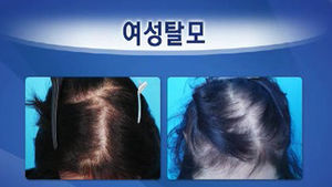 여성 탈모 20% 증가&hellip;늘어가는 여성 탈모의 원인은?