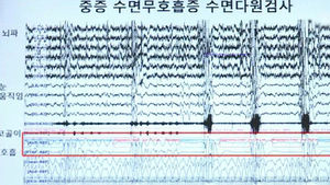 [건강] 수면무호흡증, 돌연사 원인 될 수 있어
