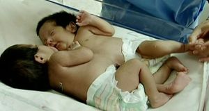 [영상] '20만 명 중 1명' 샴 쌍둥이 태어나
