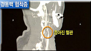 [건강리포트] 뇌졸중 부르는 경동맥협착증&hellip;50대부터 정기검진 필요