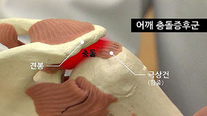 [건강리포트] 어깨통증 환자 절반은 '충돌증후군'