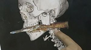 [영상] 억세게 운 좋은 여성, 작살이 목에 관통하고도&middot;&middot;&middot;