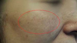 [건강] 봄철 자외선에 생긴 기미&hellip;예방법은?