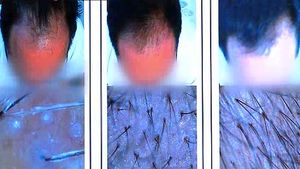 [건강] 중기 이상의 남성형 탈모, 모발이식수술로&hellip;