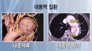 "복부 대동맥 질환, 혈압 관리가 가장 중요"