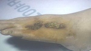 손발 썩는 '버거병' 여성환자 늘어&hellip;금연 중요